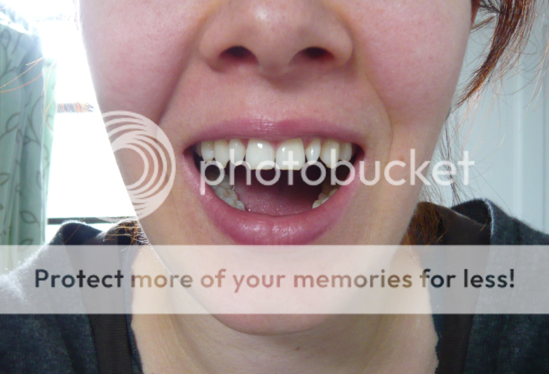Closer Front teeth